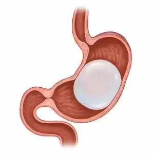 بالون المعدة: حل مؤقت أم مشكلة دائمة؟ حبوب التنحيف التركية 150G Slim بالون المعدة